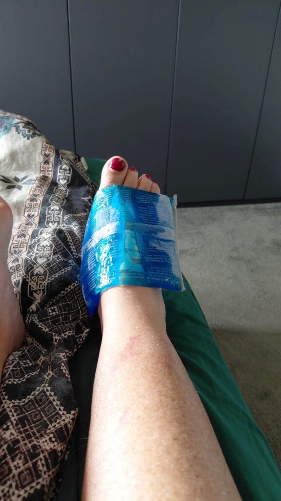 Icing swollen foot